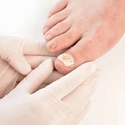 FOOT INFECTION TREATMENT